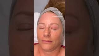 Plasma Pen  Subnovii Upper Eyelid Lift  Plasma Pen procedure  Blepharoplasty non surgical [upl. by Enobe398]