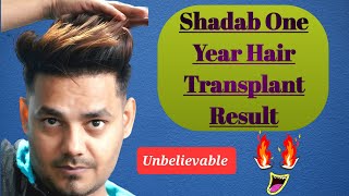 Shadab Hair Transplant Surgery Result After 1 Year amp how he styles his Amazing Hair Eugenix clinic [upl. by Shaya402]