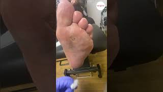 Severe Forefoot Corn Removal [upl. by Ataymik693]