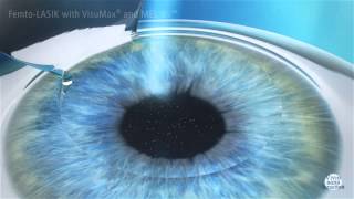 Femto Lasik Opération des yeux par laser  Myopie Hypermétropie Astigmatisme par laser [upl. by Sidonia]