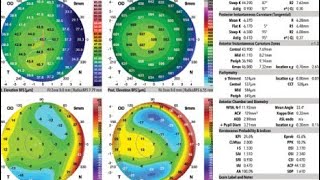 corneal topography galilei g 4 scan eye allergy test laser Urdu Hindi [upl. by Oliana]