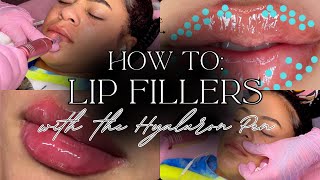 How to do Lip Filler w the Hyaluron Pen  Hyaluron Pen Tutorial  hyaluronpen hyaluronicacid [upl. by Marozik]