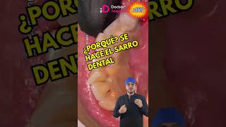 Así se crea el sarro dental dentista shorts limpiezadental higienedental gingivitis dientes [upl. by Henrieta]