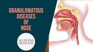 GRANULOMATOUS DISEASES OF NOSE part 3 mucormycosis wegeners granulomatosis in detail [upl. by Margit]