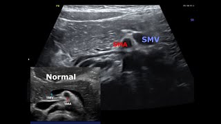 Midgut malrotation in Ultrasound  No volvulus [upl. by Alilak]