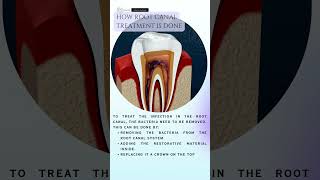 Basics About Root Canal Treatment dentist rootcanaltreatment [upl. by Myrta]