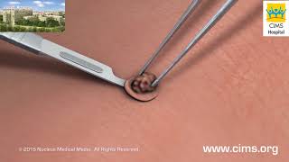 Skin Biopsy  CIMS Hospital [upl. by Jain]