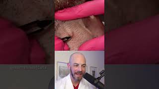 Derm reacts to ingrown hair pimple pop combo dermreacts doctorreacts pimplepop ingrownhair [upl. by Finegan843]