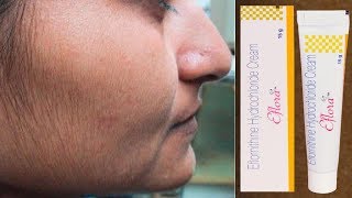 Eflora Cream for Facial Hair Removal  Eflora cream uses in Hindi [upl. by Vyky]