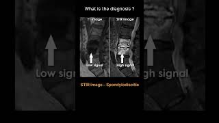 STIR image – Spondylodiscitis Quiz 16 radiologychannel007 [upl. by Aneema]