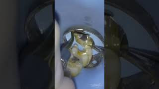 Last molar deep distal cavity filling shorts toothfilling rubberdam [upl. by Jacy]