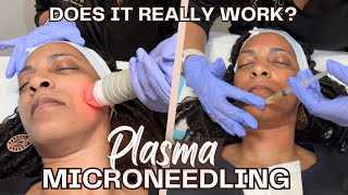 Full Process of my PRP Microneedling for the 1st Time  Will it work [upl. by Elvie]