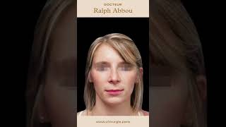 Résultat 1 mois après rhinoplastie ultrasonique  Dr Abbou [upl. by Hars]