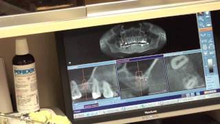 EXPLICIT  Internal Sinus lift  Osteotome technique  Dental Surgery [upl. by At]