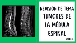 Revisión de Tema Radiológico Tumores de la Médula Espinal Aproximación Diagnóstica por Imágenes [upl. by Innep]