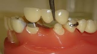 Artificial Teeth Implants [upl. by Norrek473]