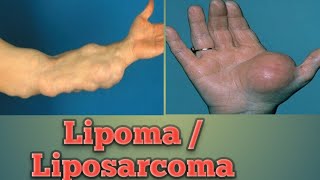 Lipoma  Liposarcoma Cancer Pathology Oncology Cancer [upl. by Eimmis]