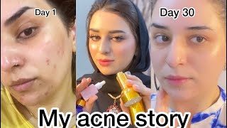 HOW I TREAT MY ACNE BEST PRODUCTS FOR FACE REVIEW [upl. by Aisatsanna]