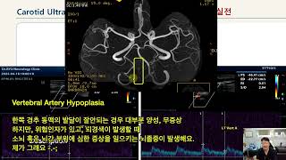 경동맥 초음파  4장 Subclavian Steal Syndrome 의대생 전공의 및 경동맥 초음파에 관심이 있는 분들을 위해 강의를 준비 했습니다 [upl. by Anilram]