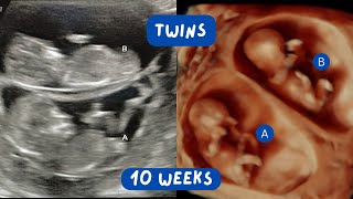 Cute Ultrasound Video of Twins at 11 Weeks Gestation  Scan of the Week [upl. by Angelica598]