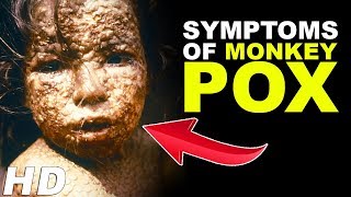 Monkey Pox Virus  Monkey Pox Outbreak  Symptoms Of Monkeypox  Infectious Disease [upl. by Stevana]