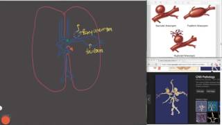 Subarachnoid Hemorrhage [upl. by Nosrej]