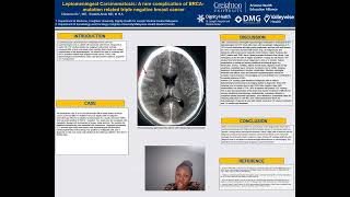 Leptomeningeal Carcinomatosis BRCAmutation related triple negative breast cancer [upl. by Ahsirtal]