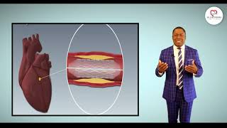 Partie 6 DrYves Frederic ANGIOPLASTIE PRIMAIRE Pose du stent pour rétablissement circulation [upl. by Purcell]