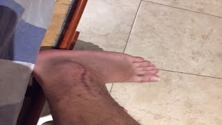 como volver a jugar futbol despues de una lesion fracturas de tobillo en futbol fractura peroné [upl. by Lawler28]