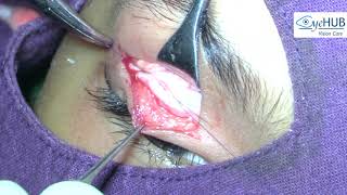 Ptosis Surgery Video amp Results1 Droopy Eyelid TreatmentCongenital Ptosis Faridabad Delhi India [upl. by Leoni]