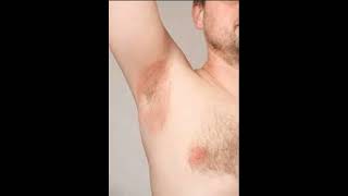 Armpit Yeast Infection healthcare health [upl. by Arrotal]