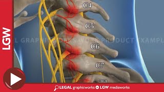 Cervical Radio Frequency Ablation animated surgery recreation [upl. by Earased]