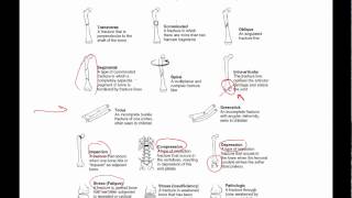 General principles of ortho trauma for PA students 1  basics [upl. by Ahidam]