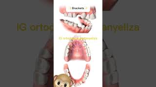 Extractions in orthodontics orthodontictips ортодонтия kieferorthopädie ortodonzia orthodontie [upl. by Justino]