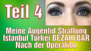 Schlupflider Operation Vorher Nachher Augenlidstraffung Erfahrung Türkei Oberlidstraffung [upl. by Aiceila787]