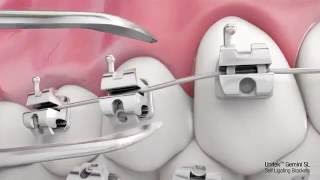 Aparelho Autoligado 【ツ】 Dentista Sorridere [upl. by Giglio]