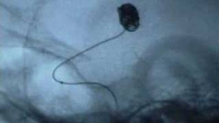 Coil embolization of aneurysm [upl. by Ahsatsan]