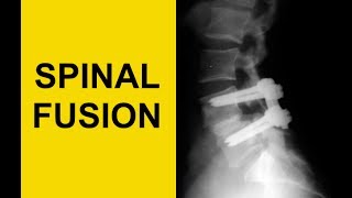 Lumbar Spinal Fusion Surgery AVOID Adjacent Segment Disease [upl. by Ari]