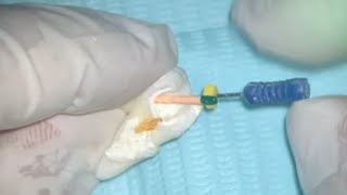 Root Canal Obturation  step by step [upl. by Ailemak]