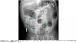 Ileocolic Intussusception Imaging [upl. by Leese]