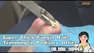 Super Thick Fungal Nails Trimming in Podiatry Office [upl. by Ayala]