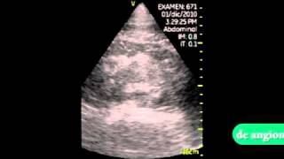 VSCAN Perirenal hematoma pocket ultrasound Hematoma perirrenal [upl. by Adeline945]