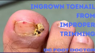 Ingrown Toenail Removal After Improper Trimming [upl. by Elleiram]