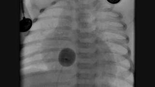 Transposition of the Great Arteries Catheterization [upl. by Hughett458]