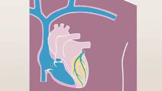 Defibrillator Implant [upl. by Joyce]