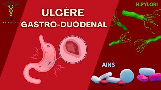 Ulcère GastroDuodenal [upl. by Aihcsrop571]