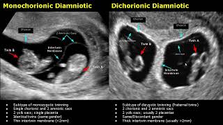 Fetal Twins Ultrasound Normal Vs Abnormal  MonochorionicDichorionicDiamnioticMonoamniotic USG [upl. by Ennovehc48]