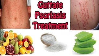 Guttate Psoriasis Treatment  Best Cure For Guttate Psoriasis With Natural Home Remedies [upl. by Kreegar]