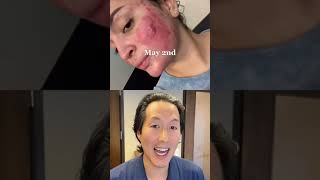 Incredible Cystic Acne Before and After shorts acne [upl. by Ahsemrac917]