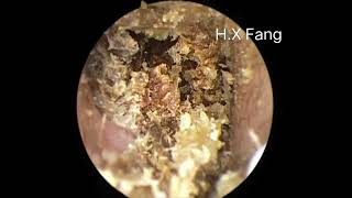 Difficult earwax removal really not easy困难的耳垢清理，真的不容易！20230826 [upl. by Hoxie]